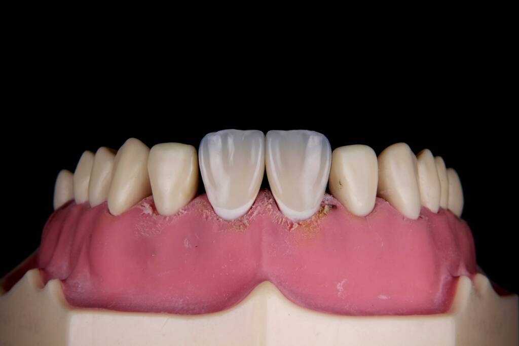 Veneer types