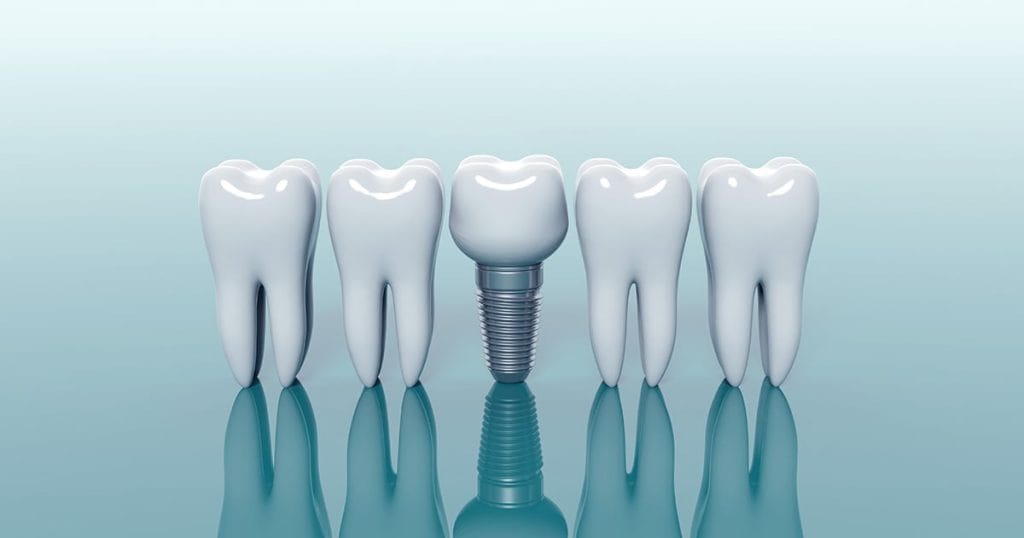 dental implants