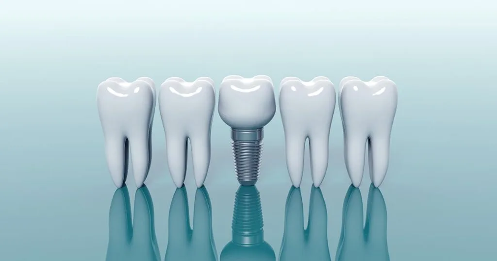 dental implants